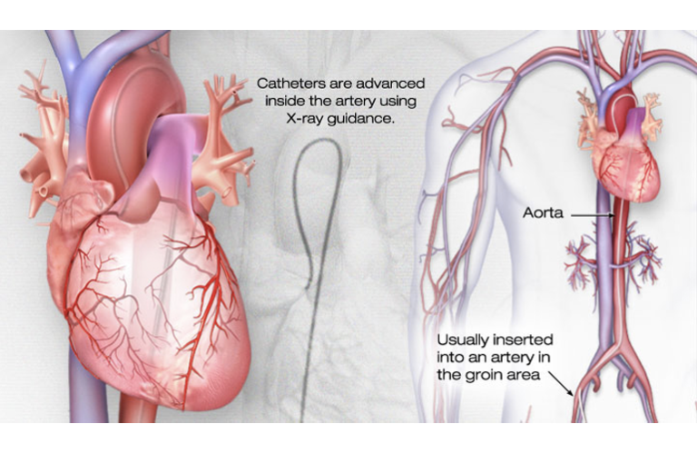 What Is Cardiac Catheterization Medical Tubing And Extrusion