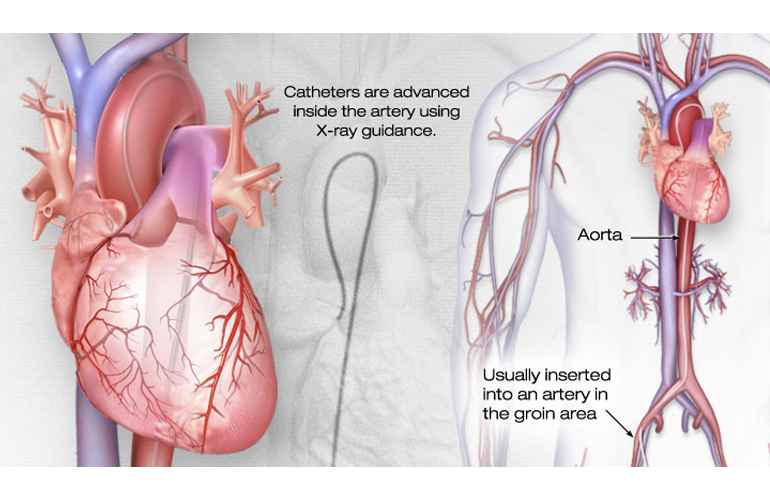 what-is-cardiac-catheterization-medical-tubing-and-extrusion