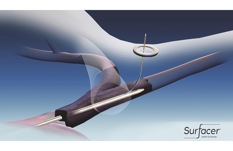 This insideout vascular access device simplifies placing catheters