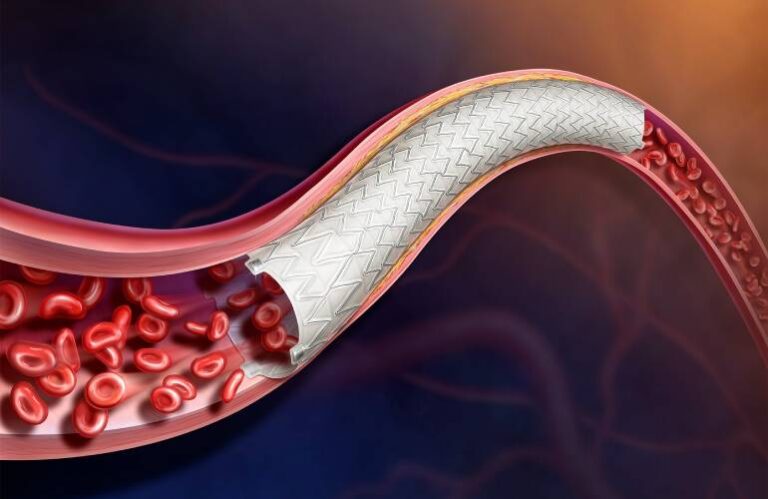 BD initiates IDE trial of stent for treating peripheral arterial disease